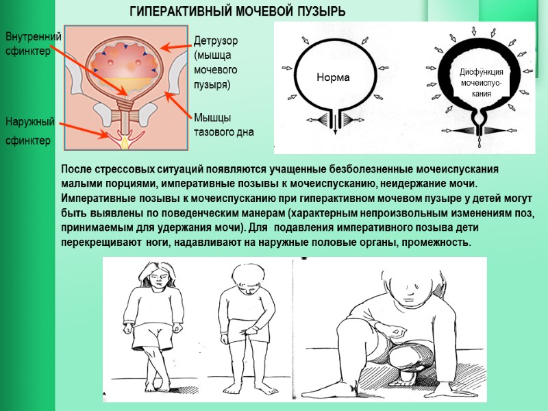 После стрессовых ситуаций появляются учащенные безболезненные мочеиспускания малыми порциями, императивные позывы к мочеиспусканию, неидержание